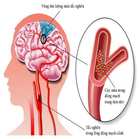 6 ĐIỀU CẦN GHI NHỚ VỀ BỆNH THIỂU NĂNG TUẦN HOÀN NÃO